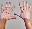 una persona muestra sus manos con vitiligo