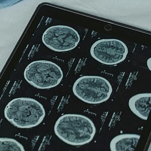 La encefalitis autoinmune es una enfermedad poco frecuente en la que el sistema inmunológico, en lugar de proteger al organismo, ataca al cerebro.
