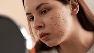 Una dieta con alto índice glucémico favorece la producción de sebo y la inflamación de la piel, incrementando el riesgo de brotes de acné. | Especial