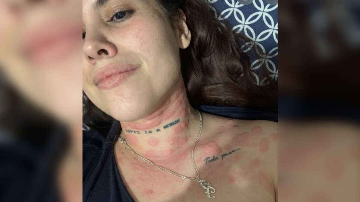 Fernanda relató que las rochan en su cuerpo le provocaban una comezón que describió como insoportable