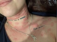Fernanda relató que las rochan en su cuerpo le provocaban una comezón que describió como insoportable